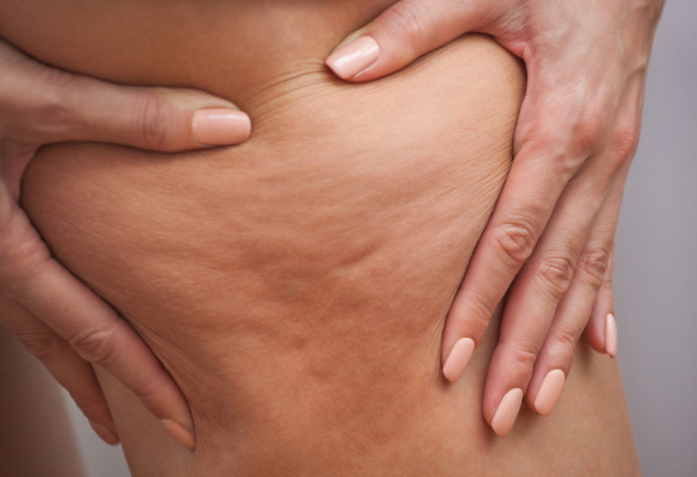 astuces naturelles pour combattre la cellulite